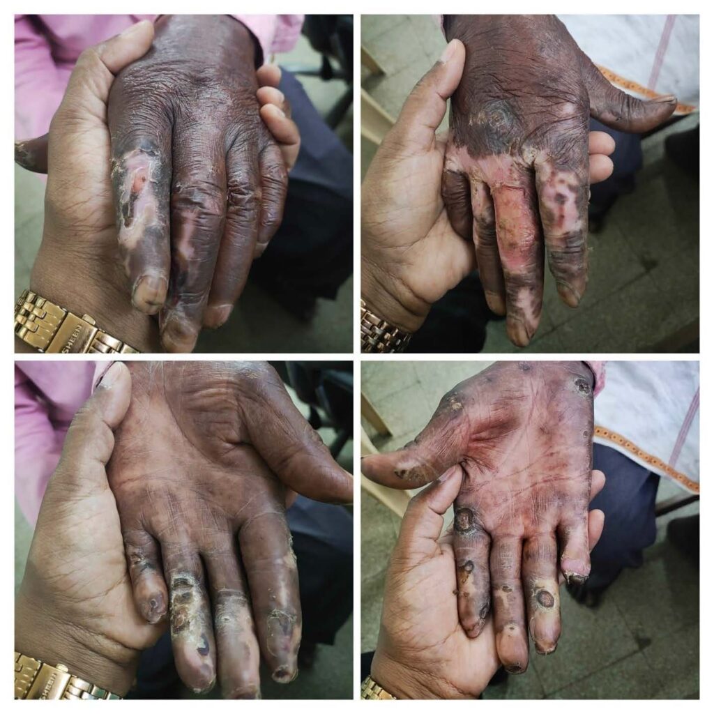 Your Donations Are Eradicating Leprosy!