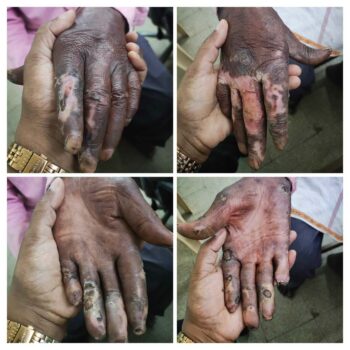 CCH leprosy damaged fingers
