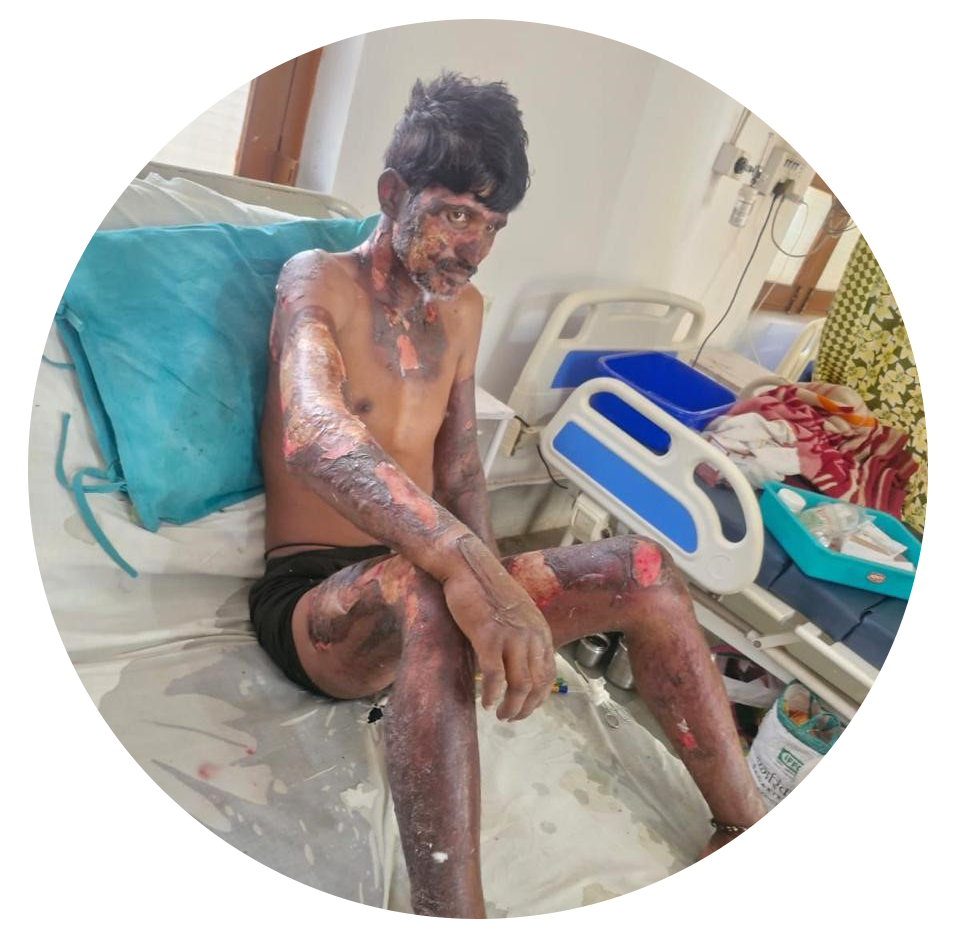 Burn Victim Saved at LCH
